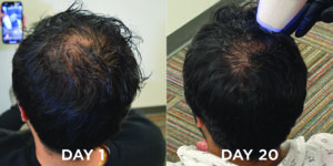 cryotouch hair restoration