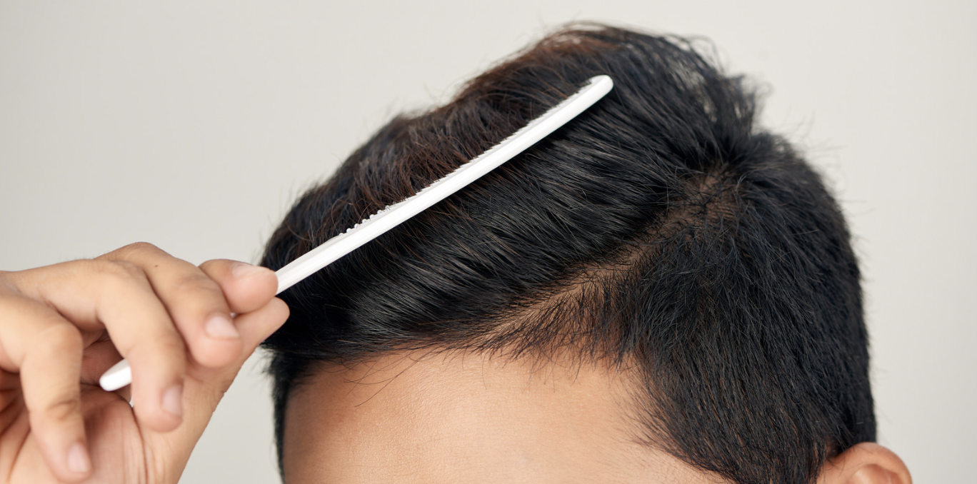 Hair Loss Treatments for Men