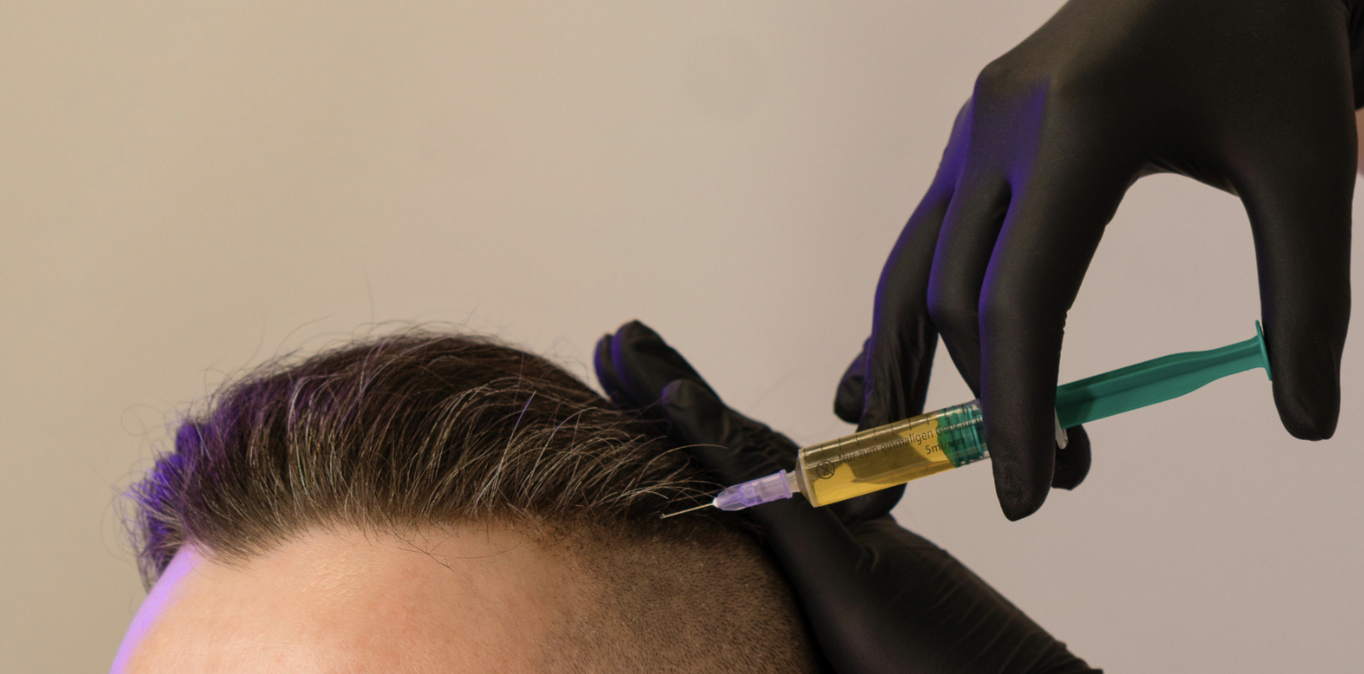 PRP Cost for Hair Loss