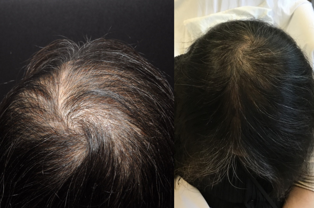 TrichoCyte Hair Restoration