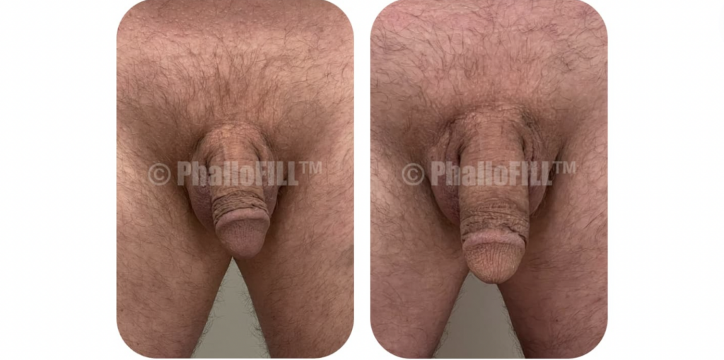 penis enhancement