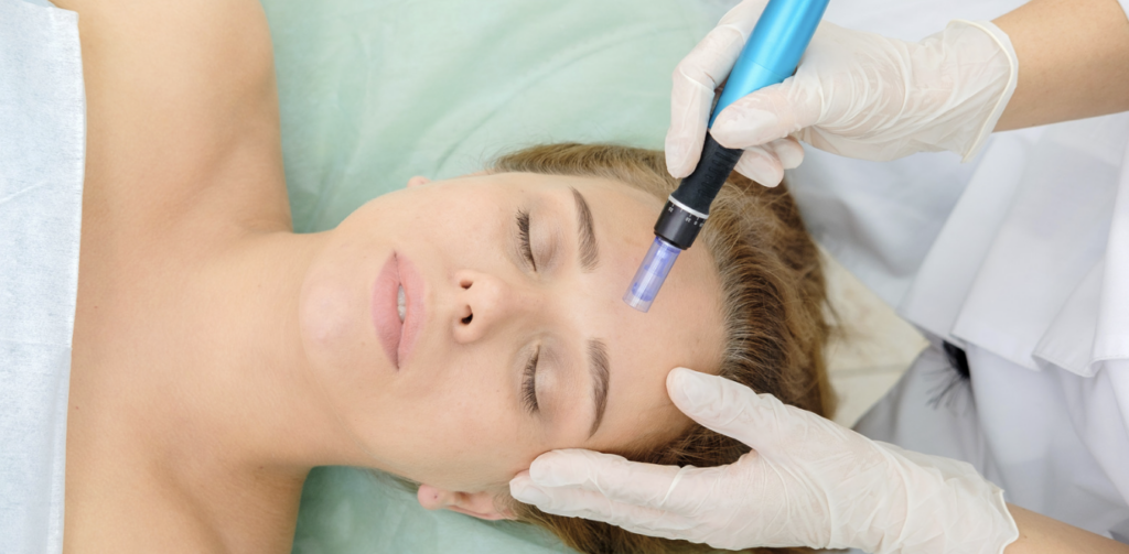 Maintaining Healthy Skin Through Microneedling in Potomac