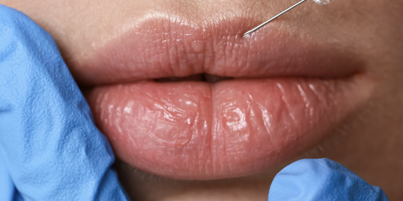 Natural-Looking Lip Filler Results Near Chevy Chase Maryland