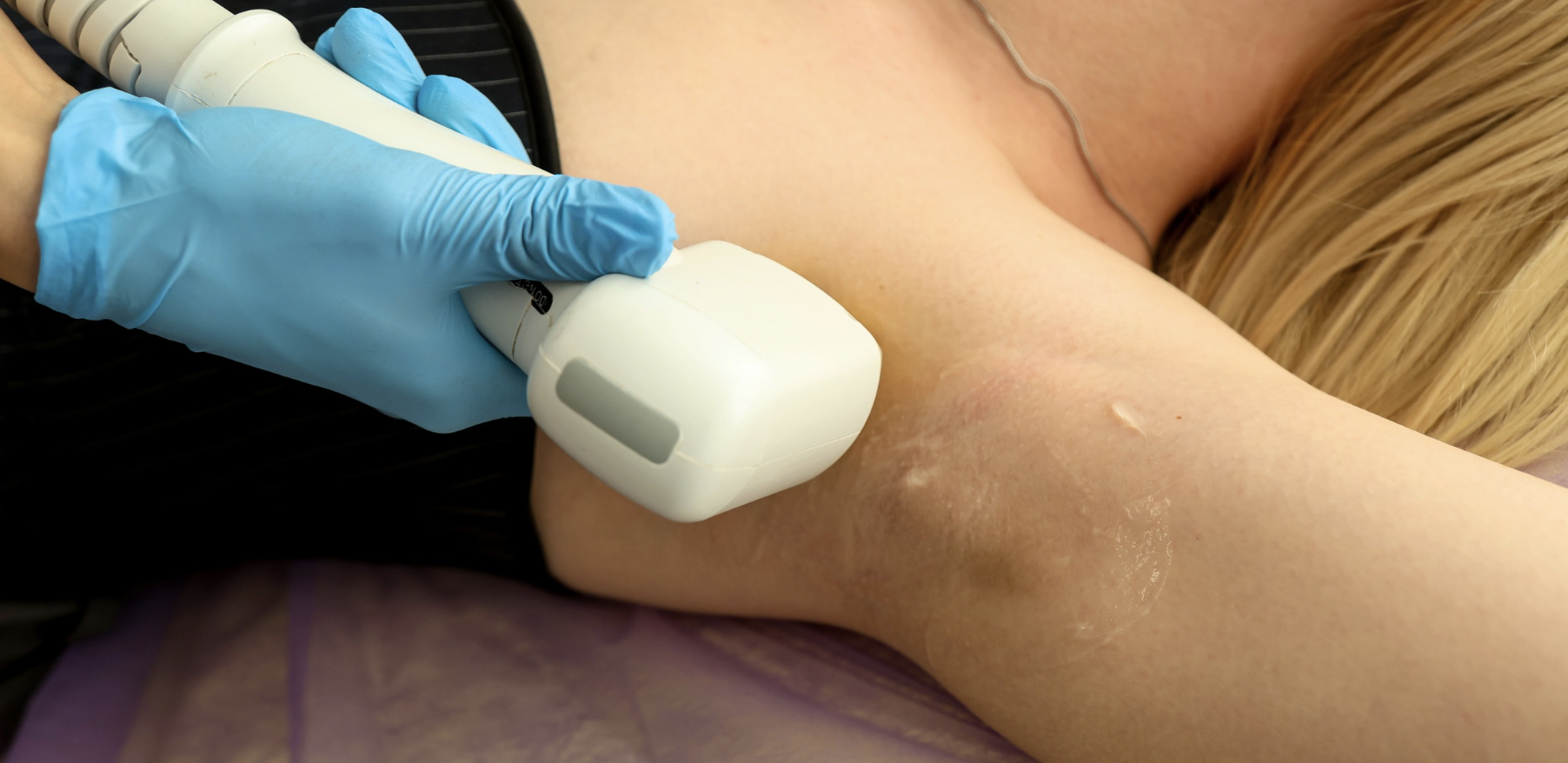 Laser Hair Removal Treatment Near Bethesda MD