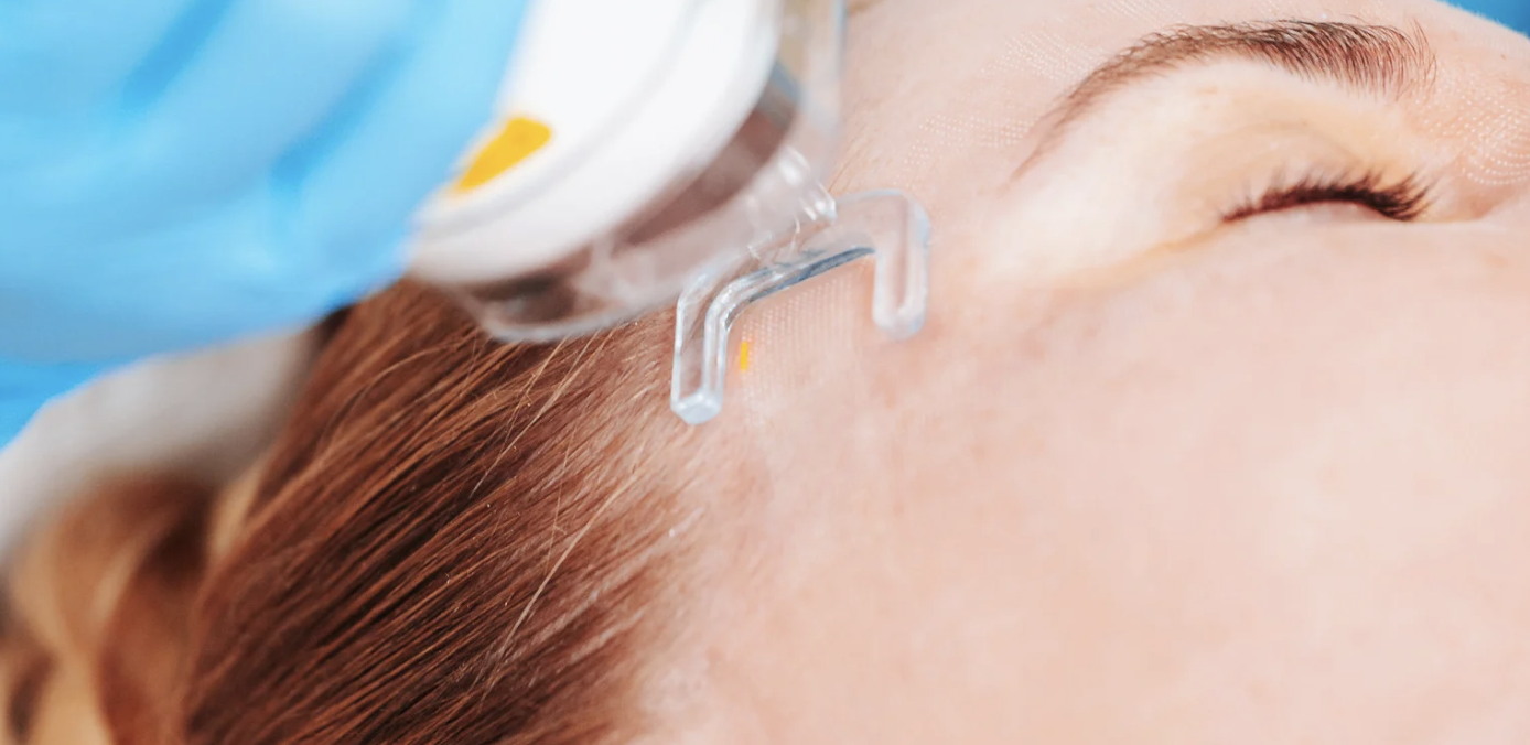 CO2 Laser Resurfacing Cost and Free Consults in Rockville Maryland