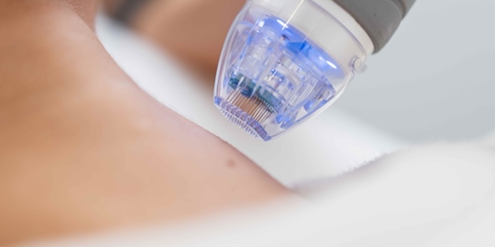 RF Skin Tightening Near Kensington Maryland