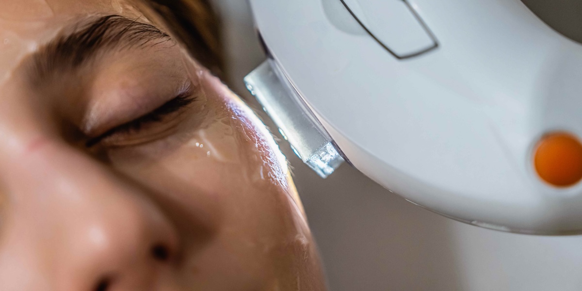 IPL Photofacial Near Potomac Maryland