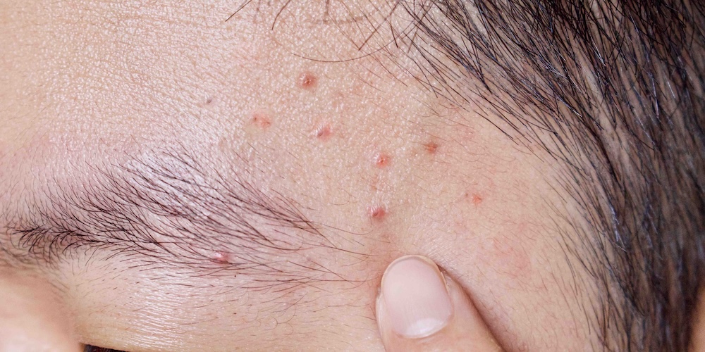 Best Dermatologist Near Silver Spring Maryland for Acne